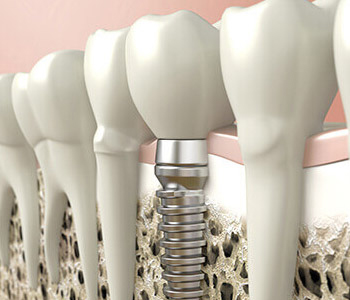 Dental Implants Cost in Piedmont NC Area
