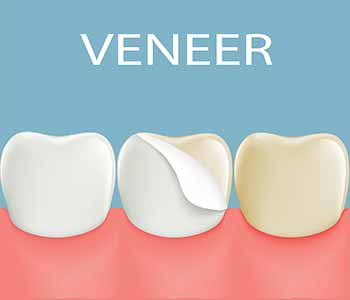 Veneers are an ideal cosmetic solution with minimal compromise of the natural tooth. 