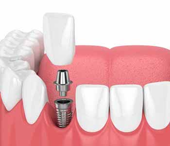 At Virtue Dental Care, recommend dental implants for many patients near the Charlotte, NC