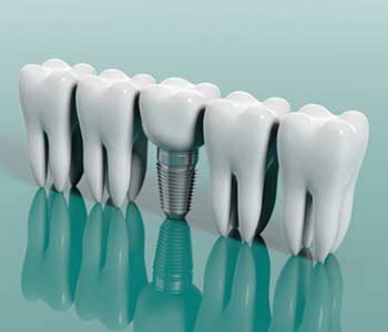 Dental Implants Treatment in, Yadkinville NC area