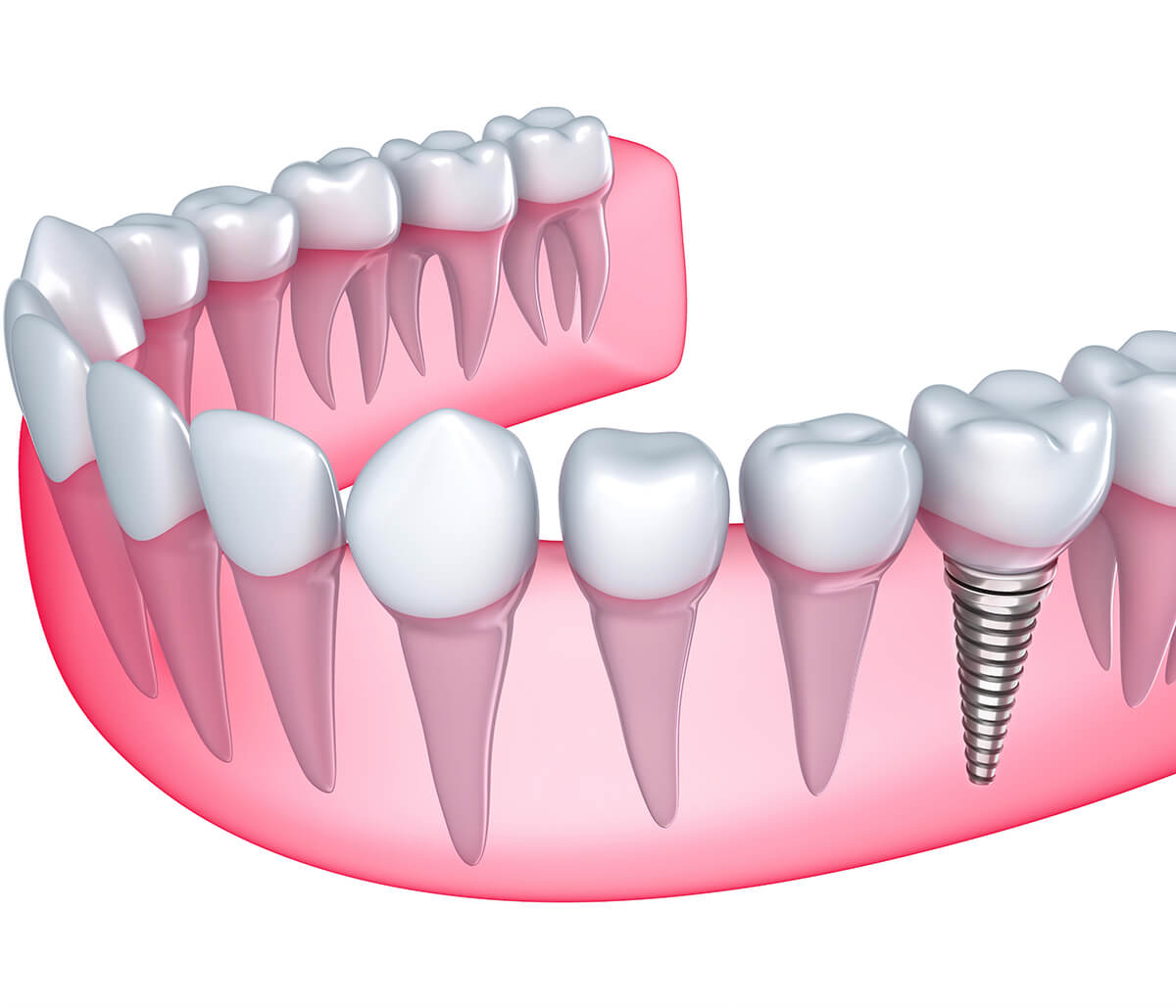 Replace Your Missing Teeth with Dental Implants Treatment in Yadkinville Area