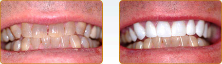 Before and After Image for Veneer in Yadkinville Area