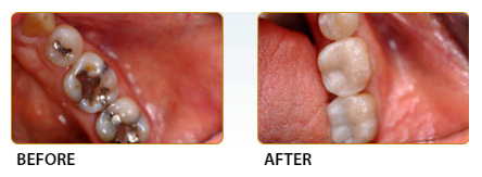 Biocompatible Dentistry Before and after Case 01