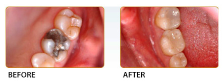 Biocompatible Dentistry Before and after Case 02